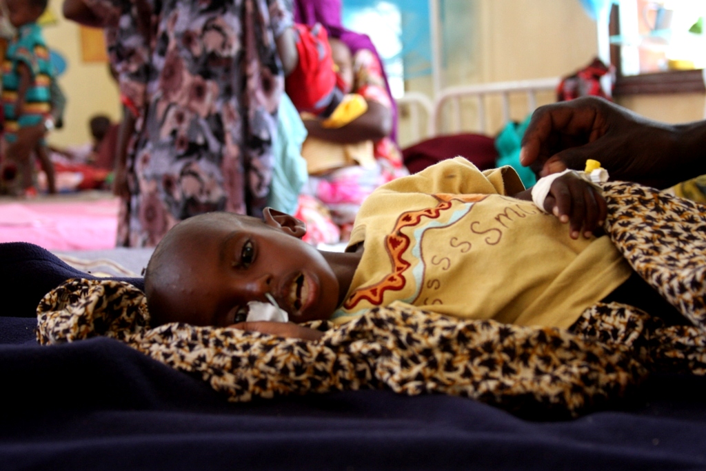 malnutrizione acuta - acute malnutrition